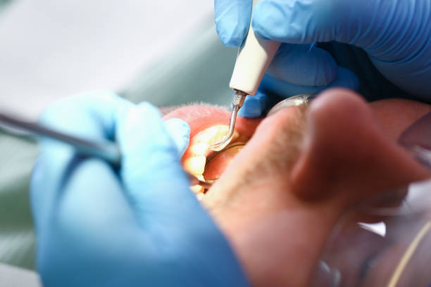 Best Emergency Dentist for Knocked-Out Tooth in Glen Carbon, IL
