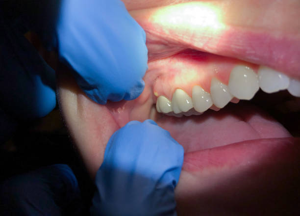Best Emergency Dentist for Lost Fillings or Crowns in Glen Carbon, IL