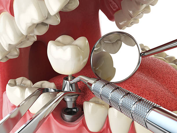 Best Emergency Dental Care for Abscessed Tooth in Glen Carbon, IL
